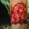 Ulcer
